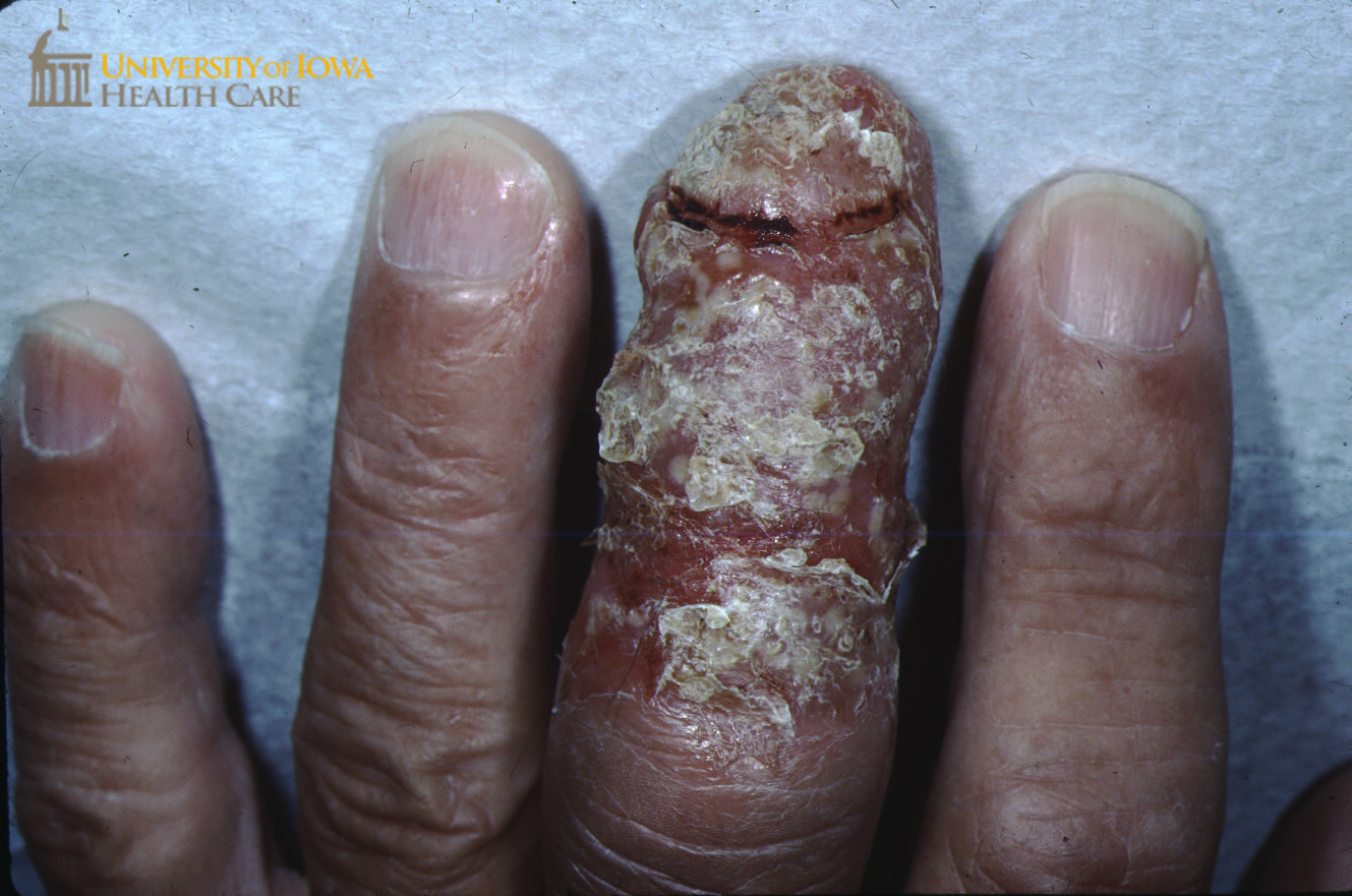 Pustules with overlying erythematous crusted plaques on the distal 3rd digit and crumbling, dystrophic fingernai. (click images for higher resolution).